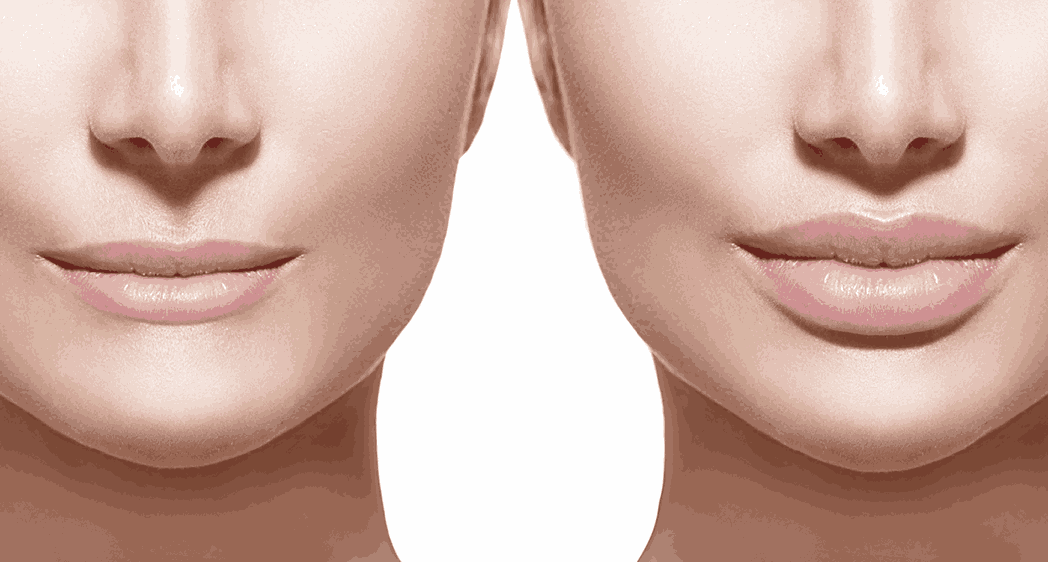 Lip Flip Before and After: Stunning Guide to Natural Results