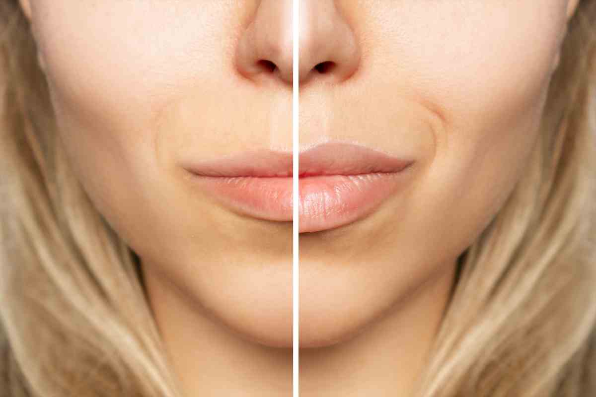 Lip Flip Before and After: Stunning Guide to Natural Results