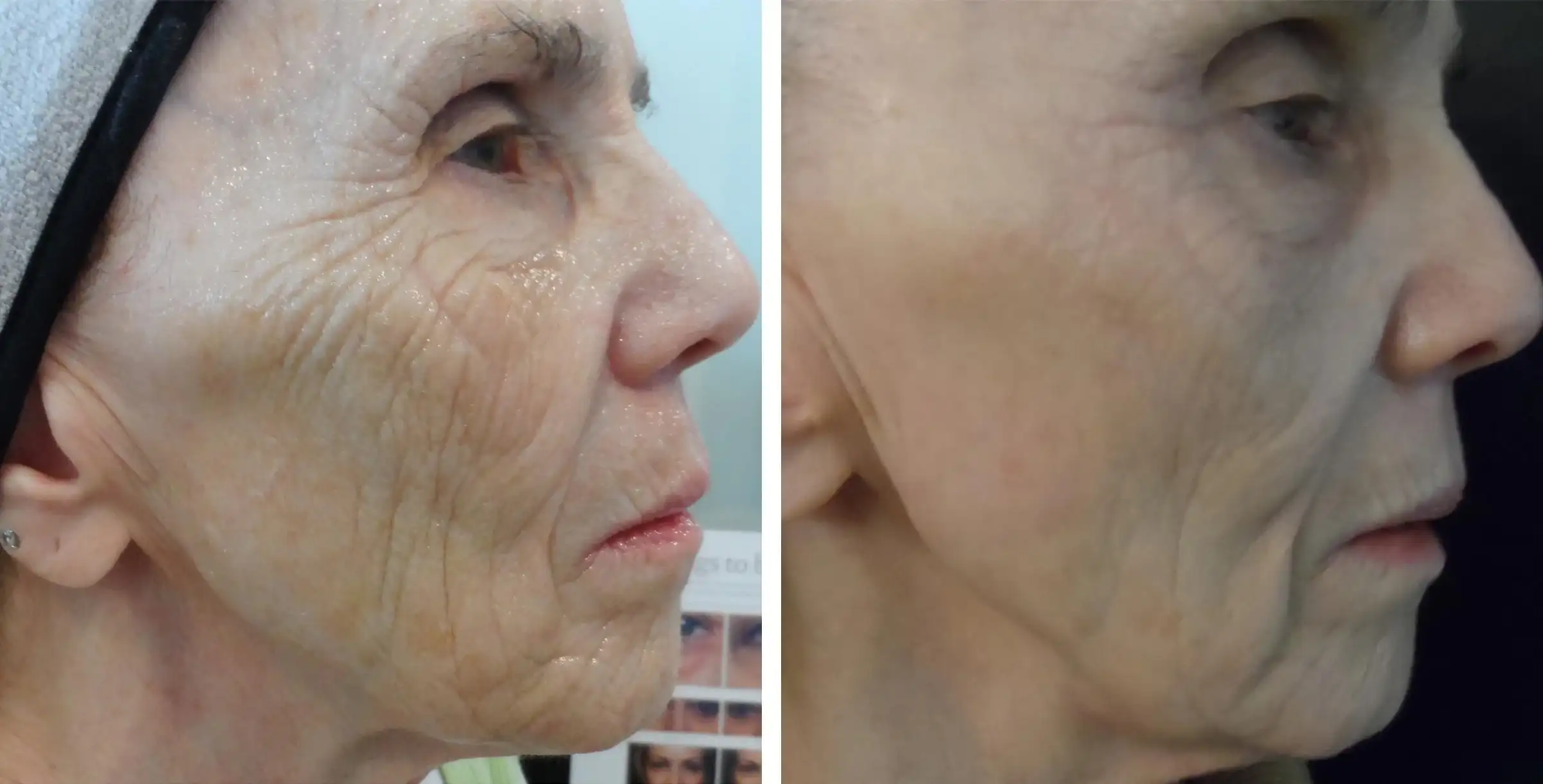 Microneedling Before and After 1 Treatment
