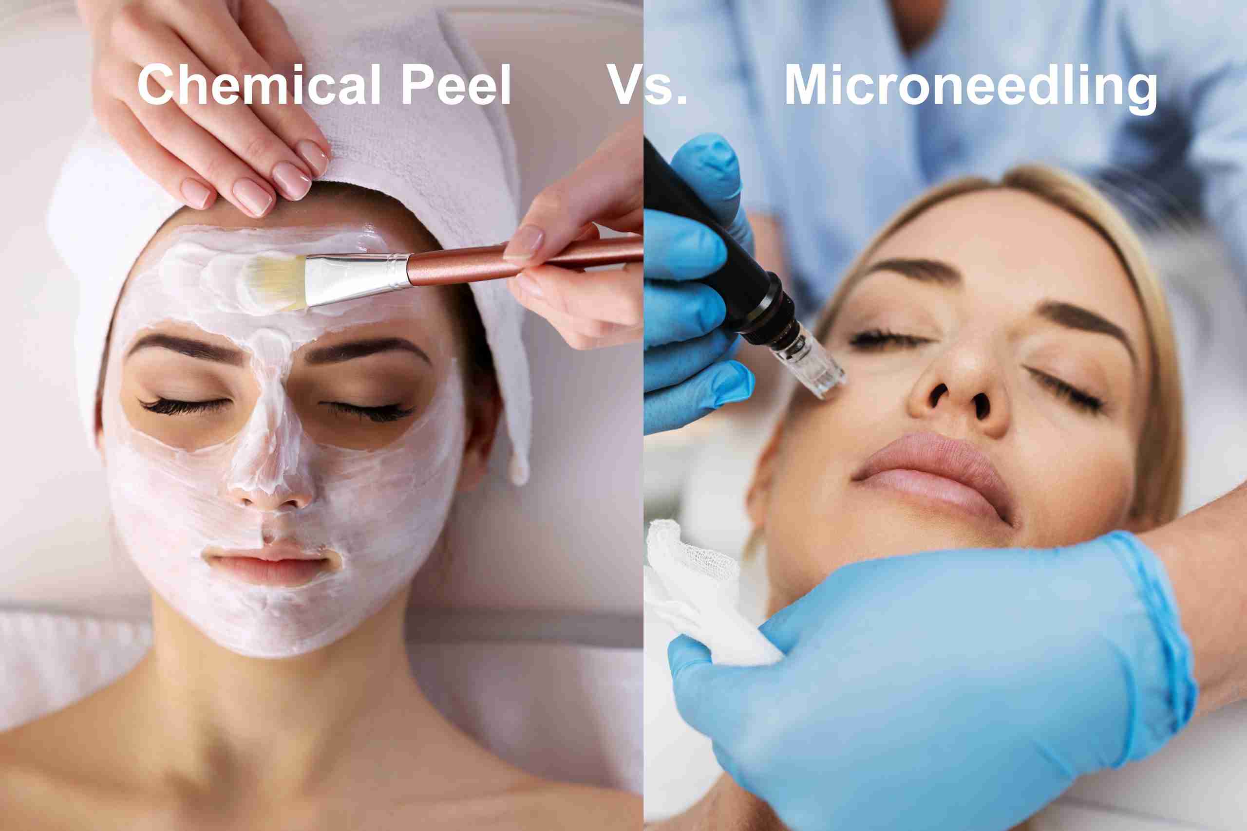 Comparing Microneedling to Other Treatments