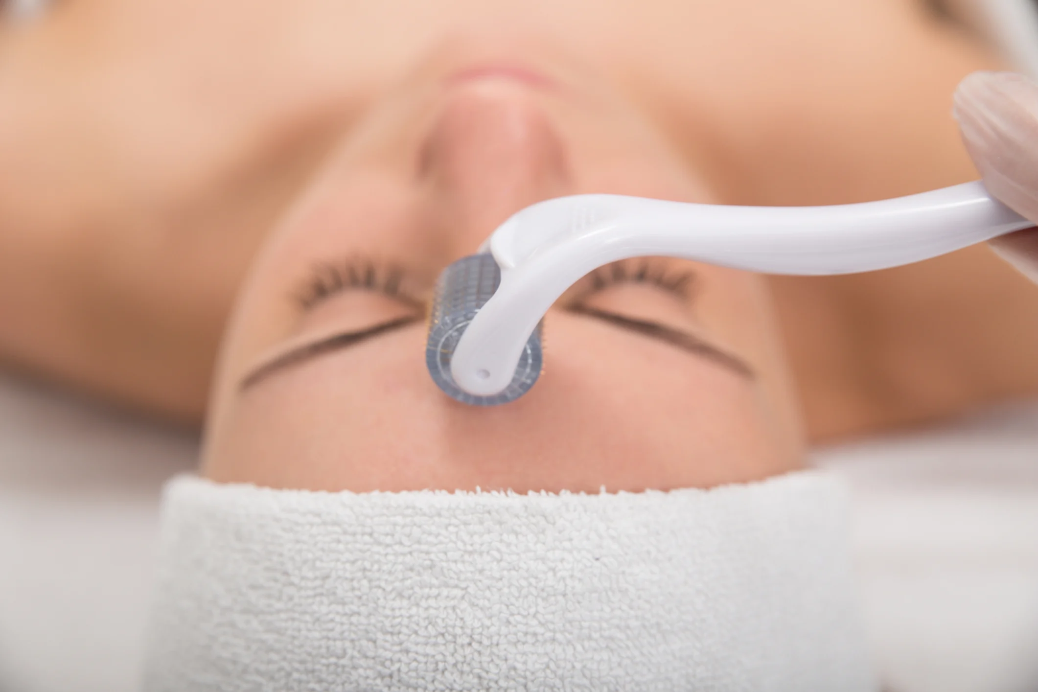 The Microneedling Process Explained