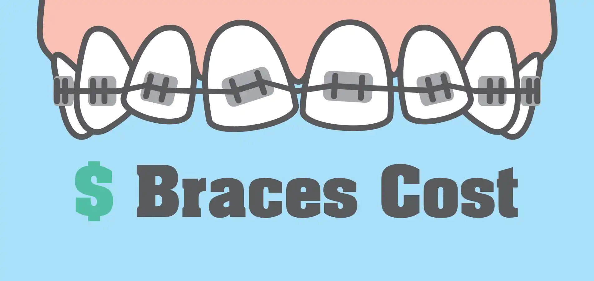 How Much Do Braces Cost? Complete Price Guide